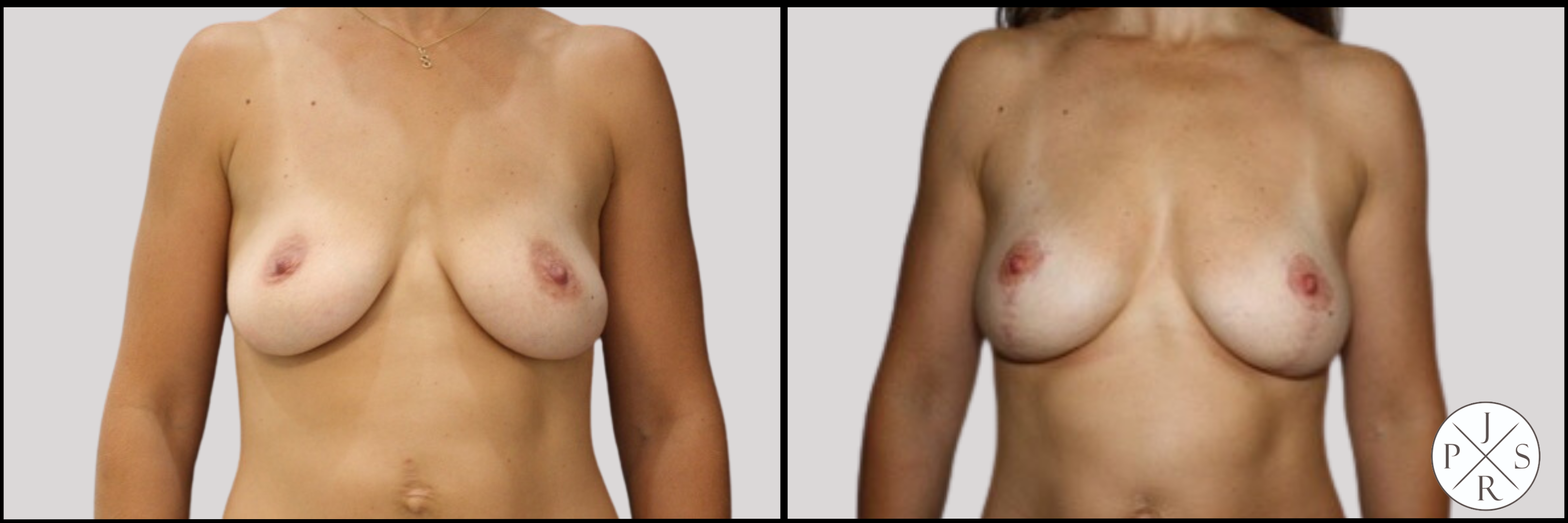 Fat Transfer Breast Augmentation Before & After Image